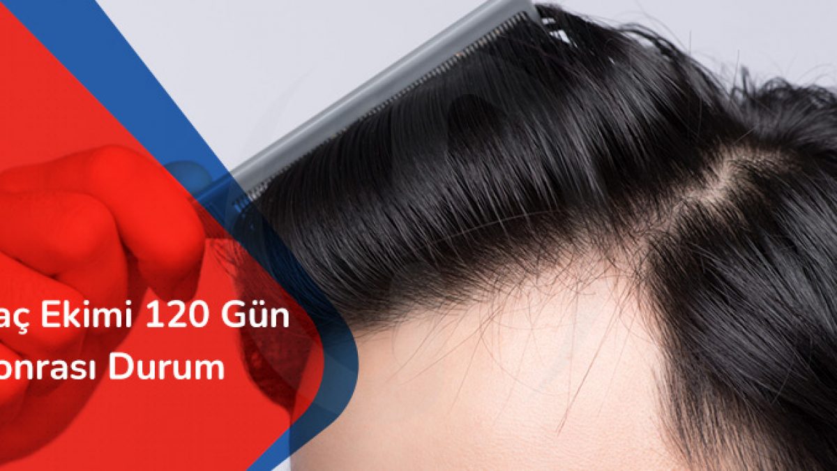 Sac Ekimi 120 Gun Sonrasi Durum Hair Heal Istanbul