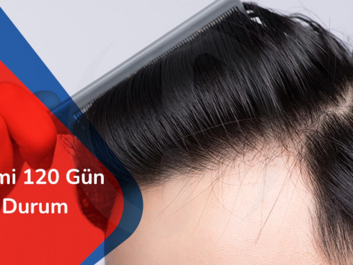 Sac Ekimi 120 Gun Sonrasi Durum Hair Heal Istanbul