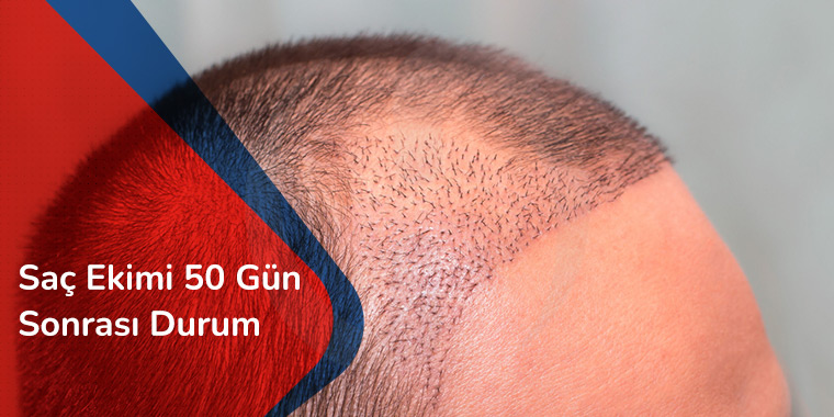 Saç Ekimi 50 Gün Sonrası Durum