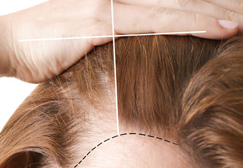 Hair Transplant Archives  Prime Hair Studio  Cosmetic Clinic
