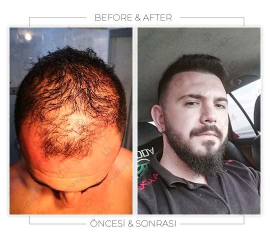 hair-transplant-before-after-03