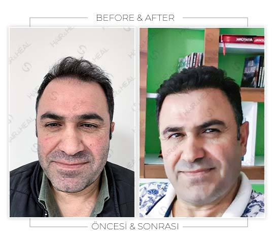 Hair Transplant Before and After