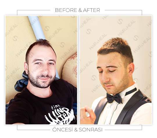 hair-transplant-before-after-05