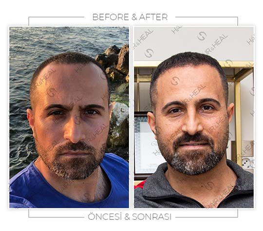 Hair&Heal Saç Ekim Merkezi 29 Hair Transplant Before and After