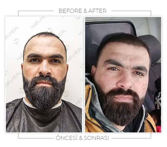 Hair&Heal Saç Ekim Merkezi 28 Hair Transplant Before and After