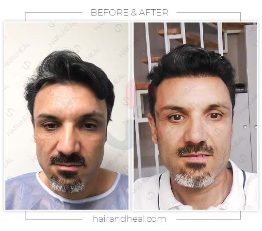 Hair Transplant Before After