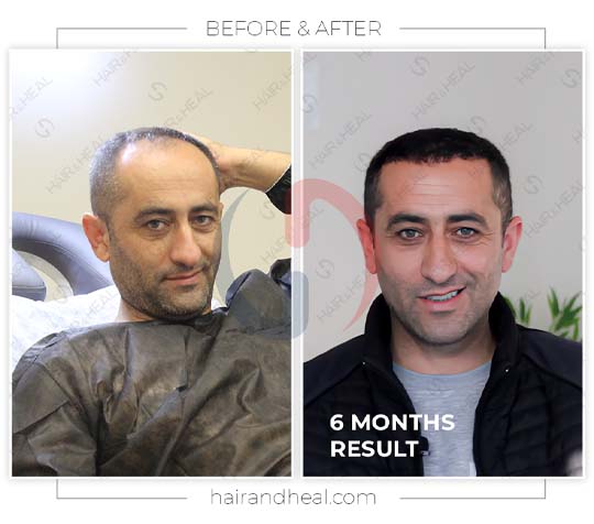 Hair Transplant Before After